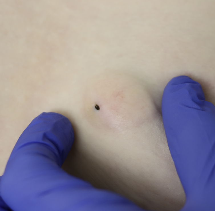 Classic sebaceous cyst at sternal border of breast with track to skin (black mark)